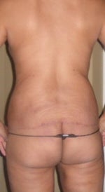 4.5 mos Post-Op
