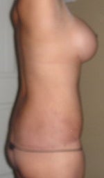 4.5 mos Post-Op 