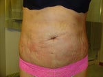 AFTER Front view 4th day of healing