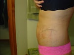 AFTER Left view 4th day of healing