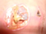 Infection