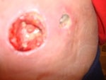 End result from surgical debribement