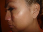 After IPL treatment photo