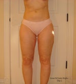 Post-op: Day 1 - March 24