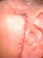Ear was shortened, stitched to face, scarred and draped 