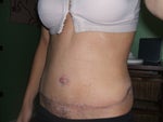 6 weeks after my tummy tuck