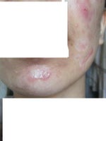5 month on
