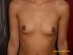 Front view pre op- (taken via digital camera) 