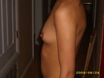 Side view pre op-left side