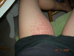 Yesterday.  Today, both legs have red welts.
