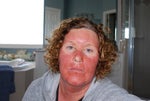 72 hours later - skin getting to feel like sandpaper
