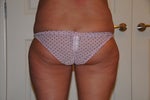 Pre-op of thighs
