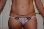 Front view pre surgery