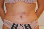 14 days post op