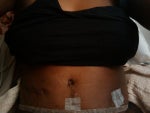 Day 2--Post-op