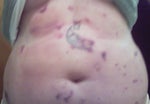 day two after the first treatment