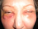 About a month after injections under eyes