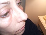 looking sideways onto right cheek (the better one) hah!