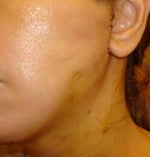 facelift dimpling/ dents