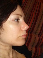 3 months after rhinoplasty