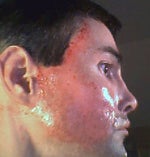 Fraxel laser of cheeks 4 hrs post procedure