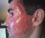 Fraxel laser of cheeks 5 hrs post procedure