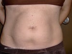 Front shot before lipodissolve