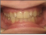 Start of treatment