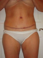 10 days post surgery - looks great, feel great!