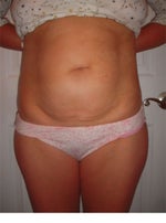 Before - lots of loose skin and hernia in belly button