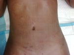 1 day post op on the table getting changed