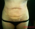 stomach lumps