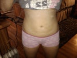 11 days post-op!