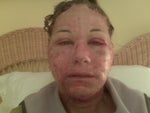 skin darkening and peeling off