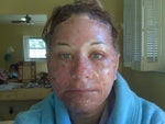greasy ointment, skin peeling off