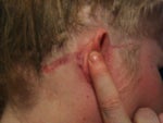 Ears after