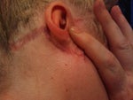 Ears after