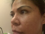 2 days post - This is my 2nd treatment