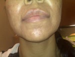 2 days post laser treatment