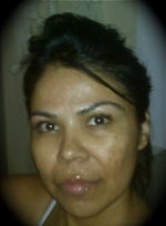 1wk prior to my 3rd Matrix RF Treatment