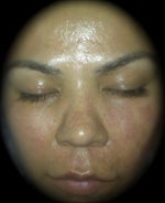 3rd treatment 9.2.09 (6hrs after)