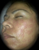3rd treatment 9.2.09 (left side)