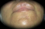 3rd treatment 9.2.09 (chin)