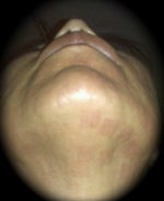 3rd treatment 9.2.09 (neck)