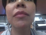 11.2 - I've been breaking out since my last treatment (Chin)