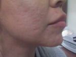 11.2 - left side (still very deep scars)