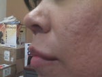 11.2 - Right Side (very visible scars)