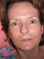 29 days, post-procedure