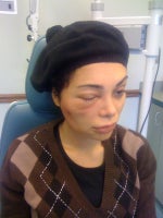 Me second time to reopen the abscess