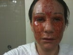 1st day right after procedure